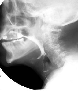MBSS image showing aspiration