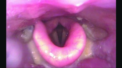 FEES image showing pharyngeal residue