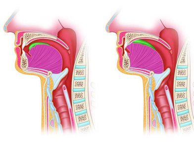 Oral transport phase of swallowing