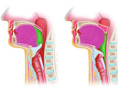 Pharyngeal phase of swallowing