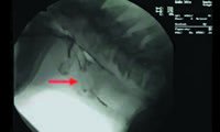 Videofluoroscopic image showing aspiration