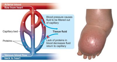 Edema due to low blood protein