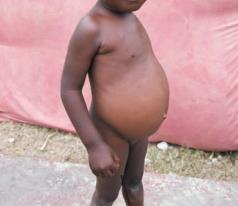Child with kwashiorkor (edema and bloated belly)
