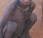 Child with marasmus (severe wasting)