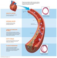 Focus: Atherosclerosis