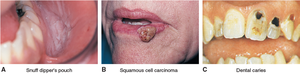 Oral conditions: leukoplakia, carcinoma, dental caries
