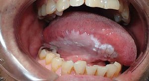 Oral thrush (candidiasis)
