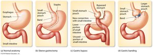 Types of bariatric surgery