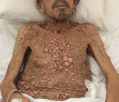 Patient with multiple neurofibromatosis showing numerous skin nodules