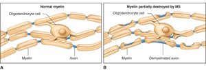 Comparison of normal myelin and myelin destroyed by MS