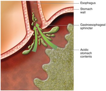 Diagram of GERD showing acid reflux into the esophagus