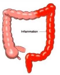 Diagram of ulcerative colitis showing continuous inflammation
