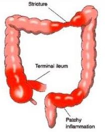 Diagram of Crohn's disease showing patchy inflammation