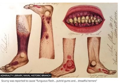Symptoms of scurvy: skin lesions and gum disease