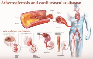 Atherosclerosis and cardiovascular disease