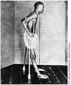 Beriberi, a thiamin deficiency disease