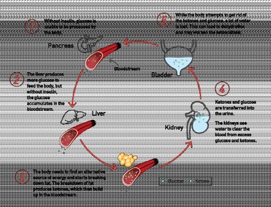 Signs and symptoms of diabetic ketoacidosis