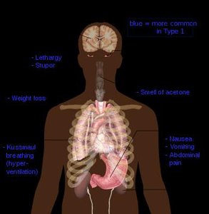 Diabetic retinopathy simulation