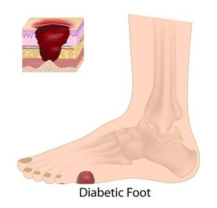 Symptoms of diabetic peripheral neuropathy