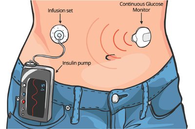 Insulin pump and continuous glucose monitor
