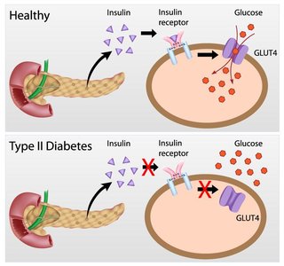Insulin resistance in Type 2 diabetes