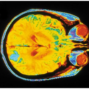 MRI scan of human brain