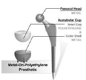 Polyethylene prosthetic (ultra-high molar mass)