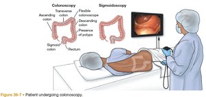 Patient undergoing colonoscopy