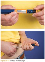 Prefilled insulin syringe and subcutaneous injection