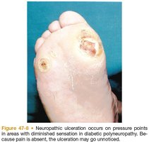 Neuropathic ulceration on diabetic foot