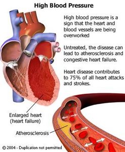 Diagram of high blood pressure and its effects