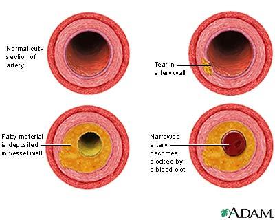 Stages of arteriosclerosis in arteries