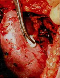 Kidney failure: graphic image of damaged kidney