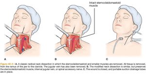 Illustration of classic, modified, and selective neck dissection