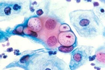 Newborn with conjunctivitis from chlamydia