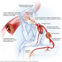 Consequences of high blood pressure on organs