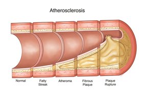 Atherosclerosis progression
