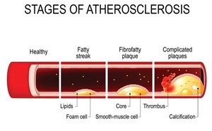 Stages of atherosclerosis
