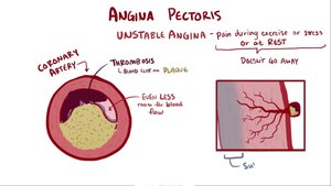 Angina pectoris and unstable angina