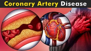 Coronary artery disease illustration