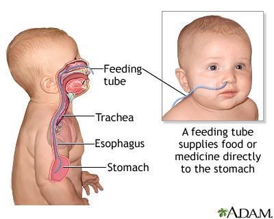 Diagram of feeding tube placement in a patient