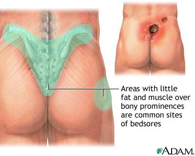 Diagram showing common sites of bedsores