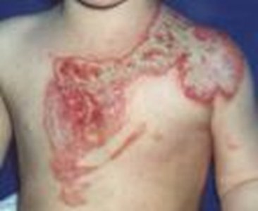 Child with burn injury on chest