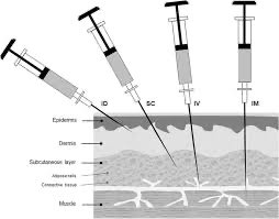 Diagram of parenteral injection routes: ID, SC, IV, IM