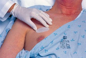 Transdermal patch application