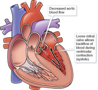 Mitral valve insufficiency diagram
