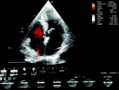 Echocardiogram showing blood flow