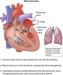 Mitral stenosis diagram