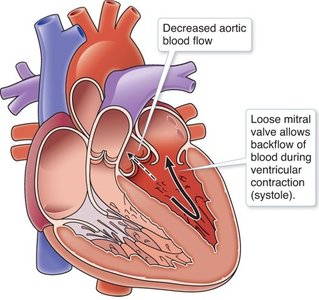 Mitral valve regurgitation diagram