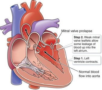 Mitral valve prolapse diagram